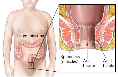 Anal Fistula