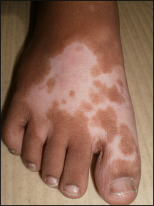 Leucoderma