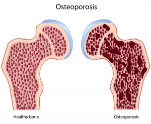 Osteoporosis