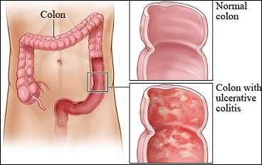 Ulcerative colitis